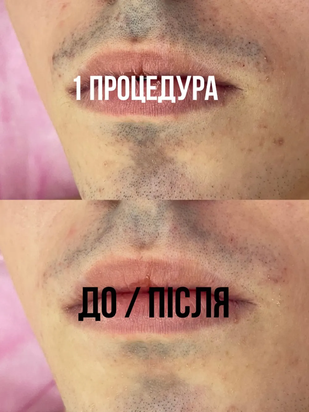 Лазерна епіляція · до / після №9